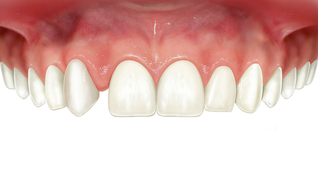 Agenesia dentale: mancata nascita di uno o più denti