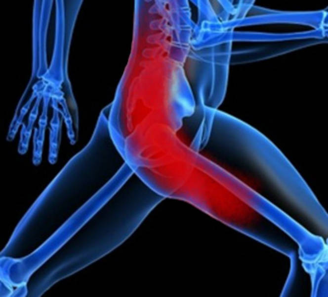 Sciatica: come prevenire e curare la sciatalgia