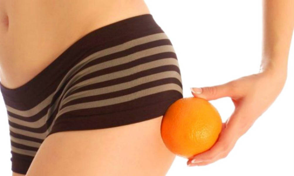 Cellulite vera o apparente? Lo rivela la lastra termografica