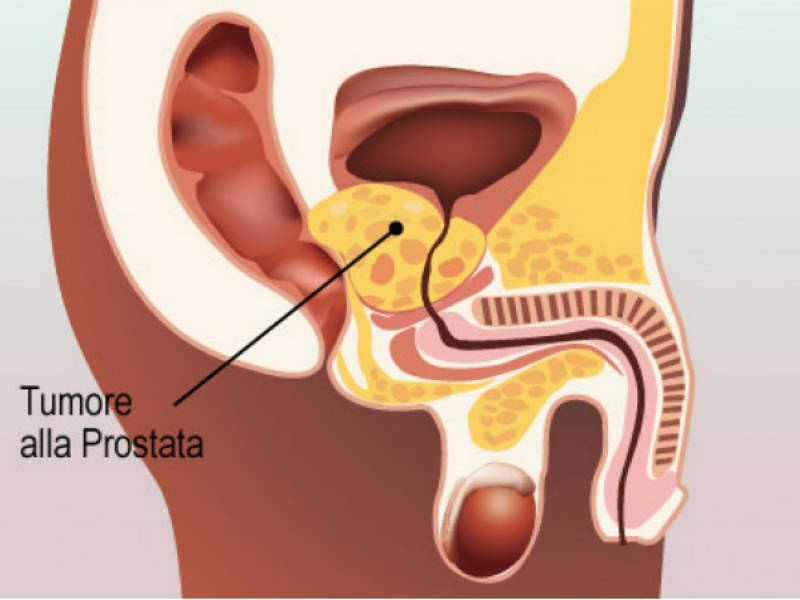 marker prostata suplimente alimentare bune pentru prostatită
