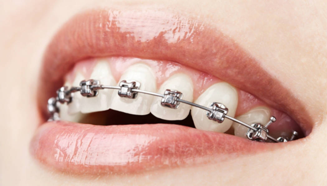 Come pulire i denti se si usa l’apparecchio ortodontico