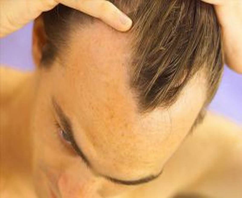 Calvizie nell’uomo: l’alopecia androgenetica
