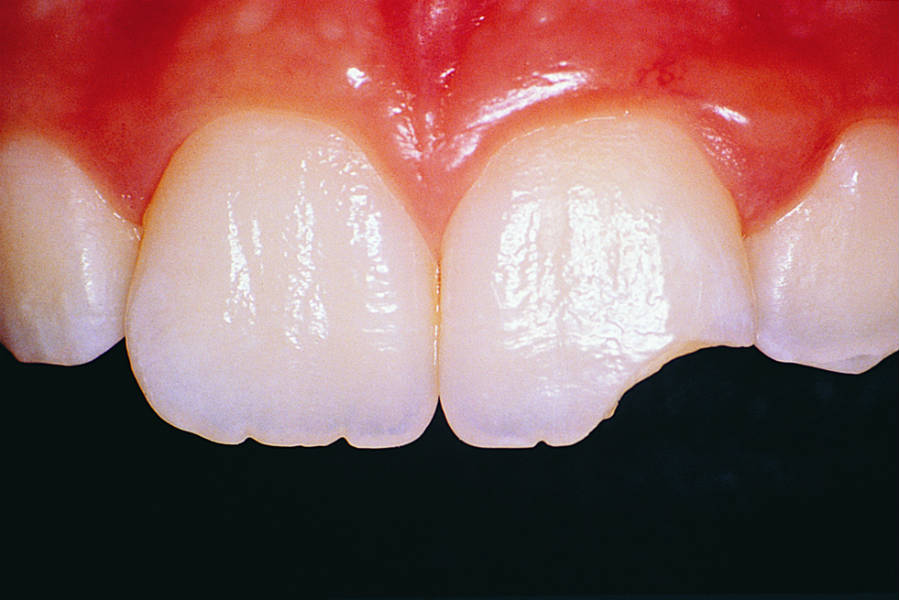 Si può riparare un dente scheggiato? 