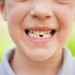 Affollamento dentale bambini