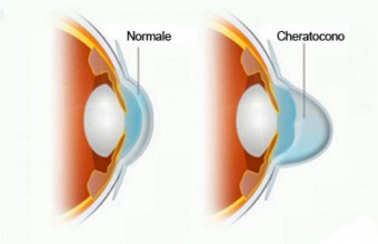 Cheratocono
