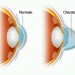 Cheratocono