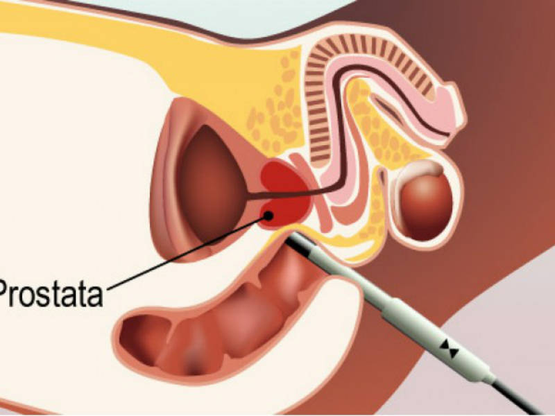 prostata ingrossata cause)