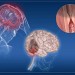 Ictus cerebrale