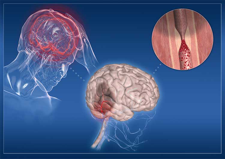 Ictus cerebrale, impariamo a riconoscerlo
