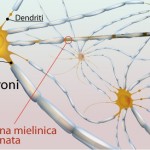 Sclerosi multipla - Ranghos