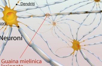 Sclerosi multipla - Ranghos