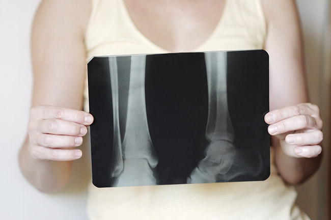 Osteoporosi: stop alle fratture in estate