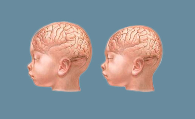 Cos’è la microcefalia infantile?