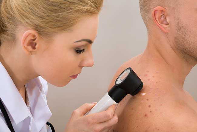 Melanoma: novità sul più aggressivo dei tumori della pelle