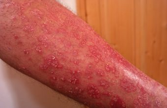 Psoriasi