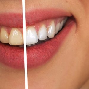 Macchie sui denti
