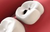 Difendere smalto e dentina per evitare la carie