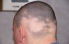 Tante sono le cause dell'antiestetica alopecia