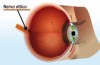 Il glaucoma malattia che colpisce il nervo ottico e porta alla degenerazione della retina