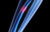 Osteoporosi: fenomeno di progressiva rarefazione ossea
