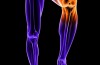 Osteoartrosi: malattia degenerativa della cartilagine delle articolazioni
