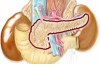 Pancreatite: infiammazione acuta, ricorrente o cronica del pancreas