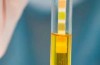 Calcoli renali sono espulsi attraverso le urine