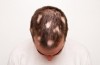 L’alopecia areata: cause