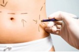 La chirurgia addominoplastica: via il grasso, via la pelle in eccesso