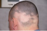 Tante sono le cause dell'antiestetica alopecia