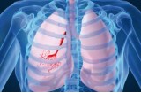 Sindrome di scimitarra: difetto congenito nel ritorno venoso del polmone destro