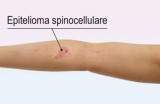 Epitelioma spinocellulare