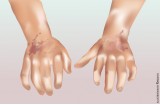 Sclerodermia