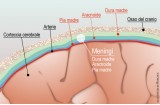 Meningite