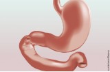 Ulcera duodenale: lesione causata da acido che colpisce la mucosa del duodeno