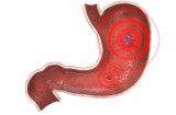 Ulcera gastrica: erosione o perforazione della mucosa gastrica, causata da acidi, bile e pepsina nello stomaco