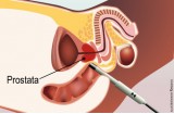 Ecografia prostatica
