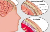 Meningite