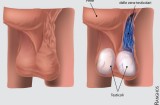Varicocele