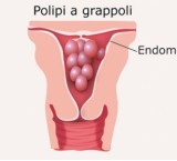 I polipi uterini: tumori benigni nella mucosa dell'utero