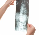 Scoliosi: deformazione della colonna vertebrale
