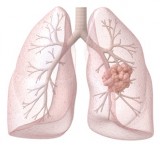 Tumore al polmone: famiglia di neoplasie polmonati, a piccole cellule e a grandi cellule
