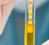 Calcoli renali sono espulsi attraverso le urine