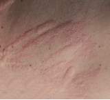 Orticaria solare: definizione e cure naturali