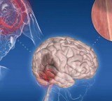 Ictus cerebrale