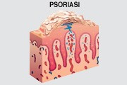 Psoriasi
