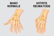 Artrite Reumatoide