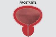 Prostatite