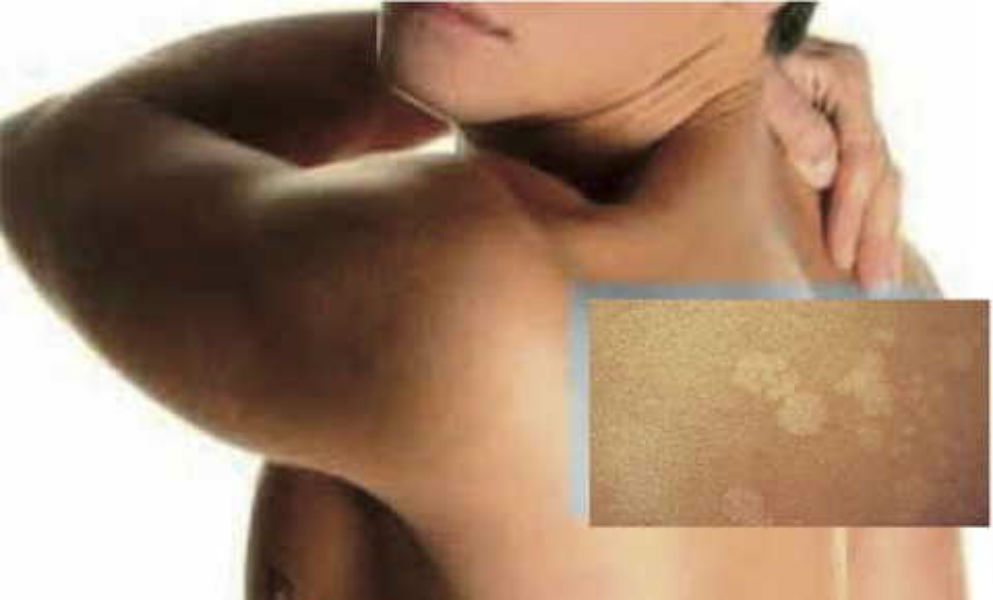 Infezioni cutanee in palestra: attenzione ai pericoli per la pelle