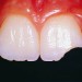 Dente scheggiato